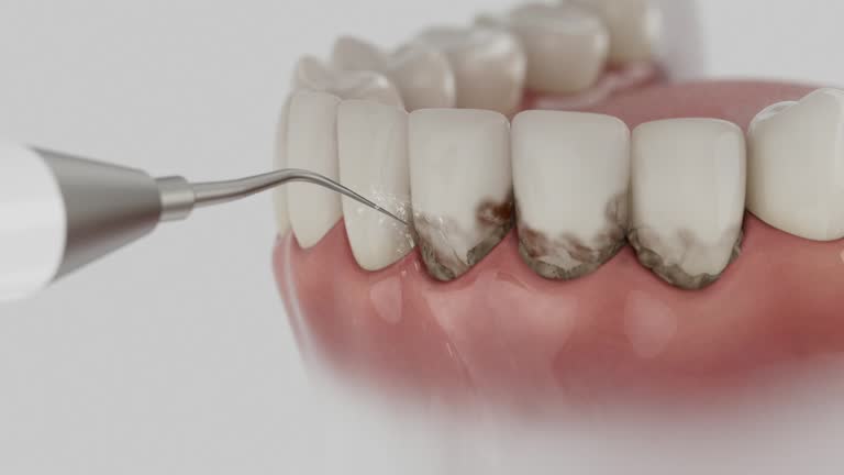 Trusted Wisdom Tooth Removal service in Ellsworth, KS - Dentist Open Now